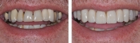 Old bridges replacing missing front teeth were treated by orthodontist to align teeth, periodontist to contour gums and place implants allowing implant crown replacement of missing teeth with matching crowns and veneers for remaining upper teeth.