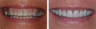 Short, discolored teeth treated by orthodontics and gum re-contouring and restored with veneers upper and lower teeth.