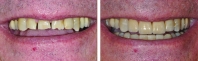 Severe tooth wear treated by orthodontics to correct bite, then worn upper teeth restored with all porcelain crowns and lower worn teeth treated with chairside veneers.