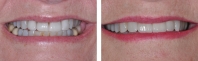 Existing broken veneers treated by orthodontics to correct bite followed by new porcelain veneers.