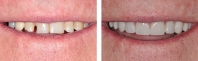 Worn, broken and short teeth treated by opening bite with porcelain restorations on all upper and lower teeth.