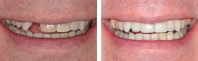 Missing tooth and discolored tooth treated by orthodontist to align bite, periodontist to place implant, endodontist to internally bleach dark tooth then an all porcelain implant crown was matched to replace the missing tooth.