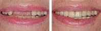 Missing front teeth treated by periodontist to place implants, then implants were restored with all porcelain crowns.