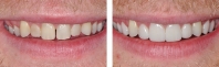 Short, discolored teeth treated by gum re-contouring then restored with all porcelain veneers.