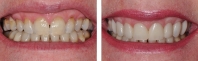 Severely eroded teeth treated by chairside veneers.
